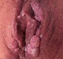 人乳头瘤病毒